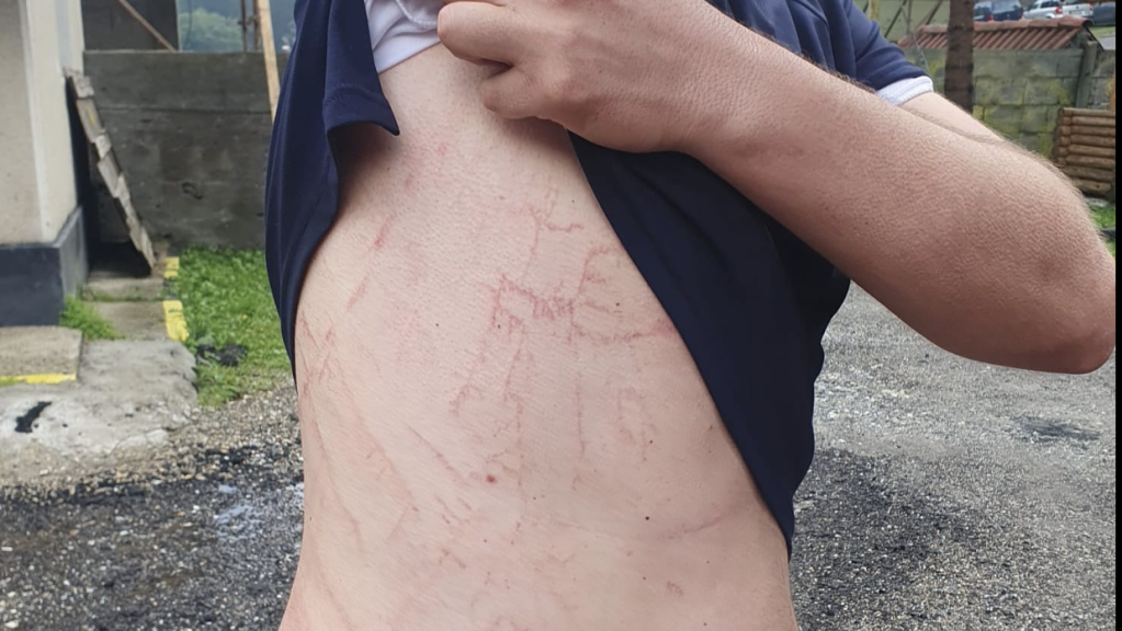 semnele lasate pe corp de un trasnet care a lovit in apropierea unui om /FOTO Salvamont Argeș - Facebook