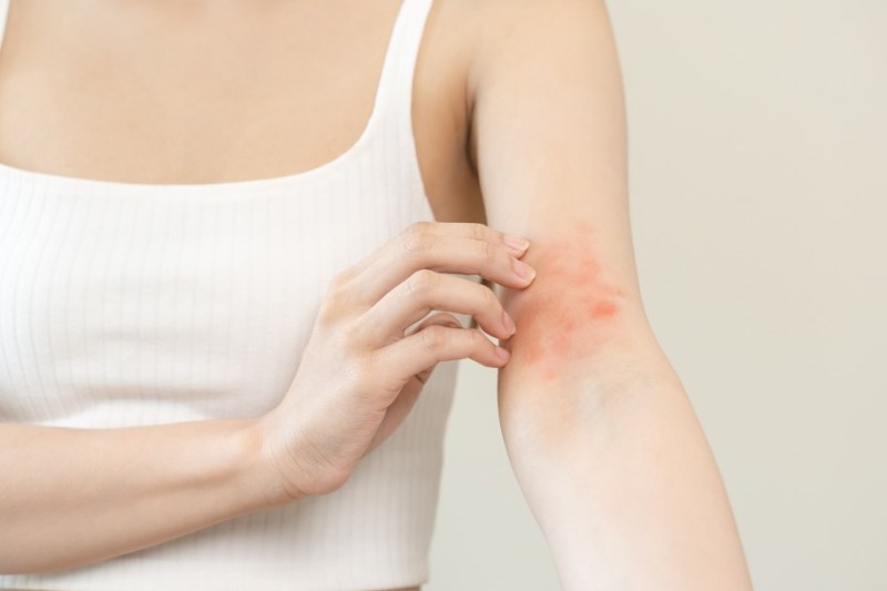 Perspectiva pacientului: Cum este să trăiești cu dermatită atopică