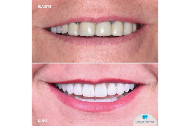 De ce să alegi implanturile dentare la Dental Premier din București? 
