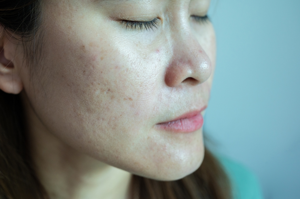 Pielea nu numai că nu ascunde problemele psiho-emoționale, ba chiar le scoate în evidență prin afecțiuni asociate. FOTO: Shutterstock