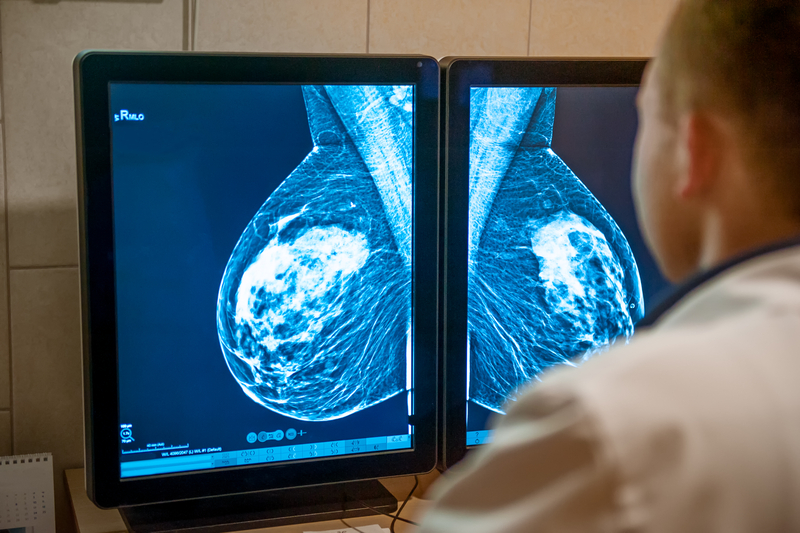 Un test genetic revoluționar poate oferi milioanelor de paciente cu cancer de sân șansa de a evita chimioterapia