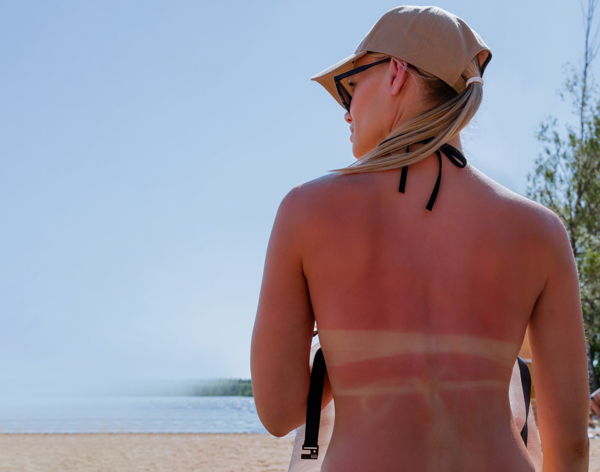 Legătura dintre arsurile solare și un tip de cancer de piele. Consecințele pot apărea și după zeci de ani