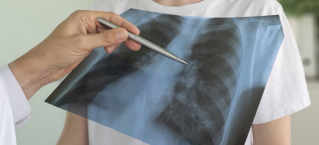 medic explică o radiografie pulmonară cu modificări